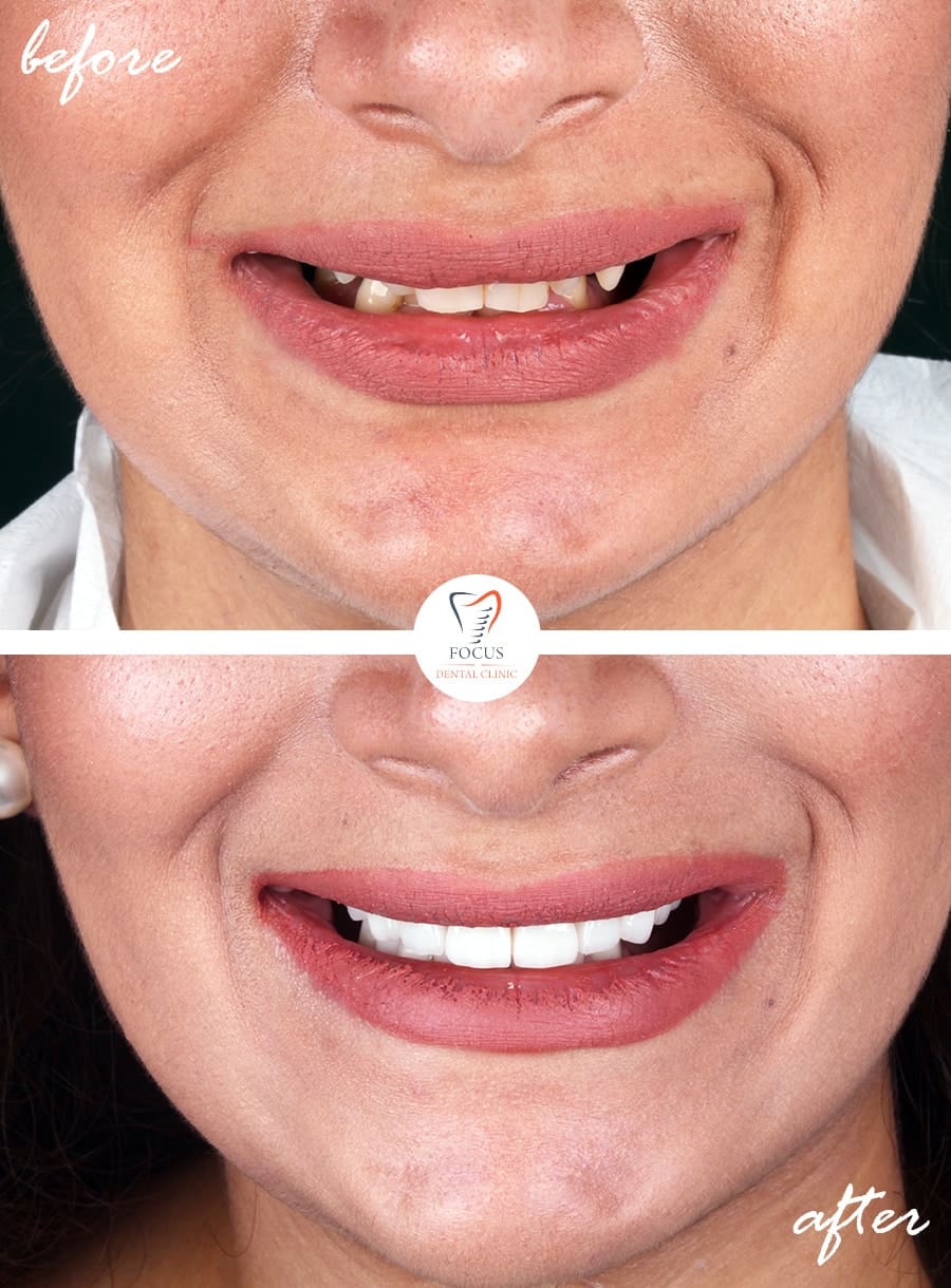 Before-After-02