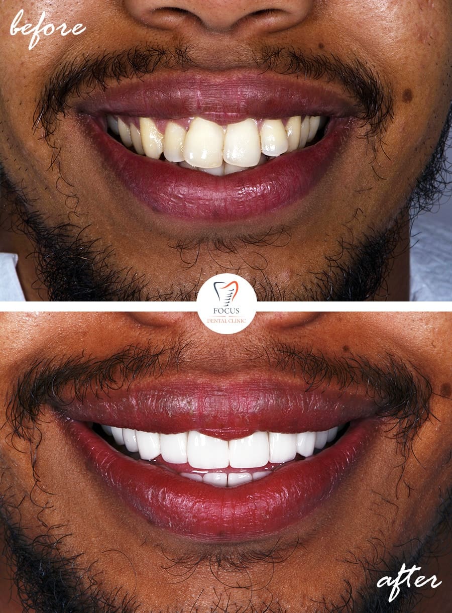 Before-After-03