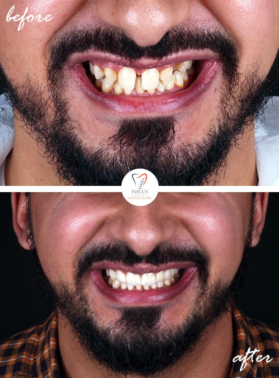 Before-After-11