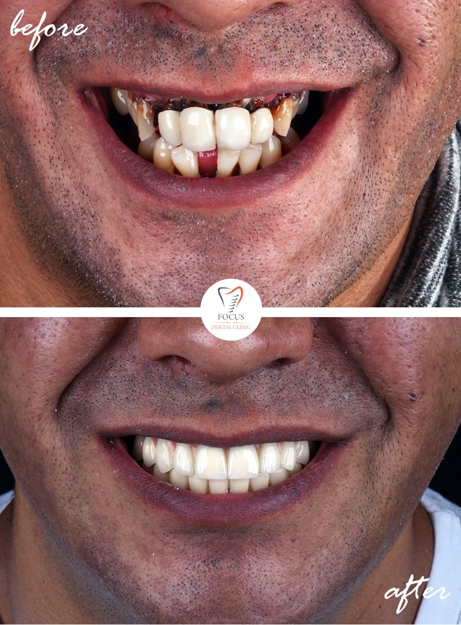Before-After-12
