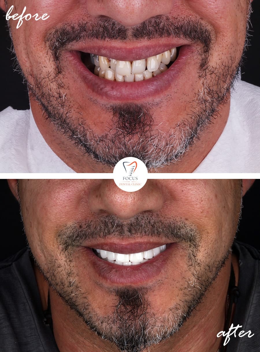 Before-After-13