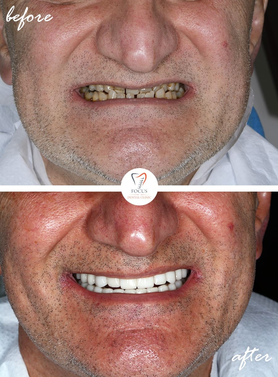 Before-After-14