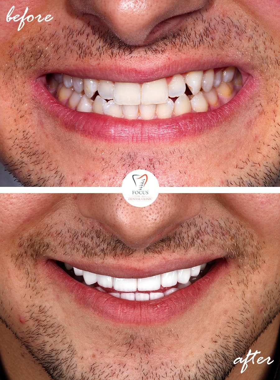 Before-After-15