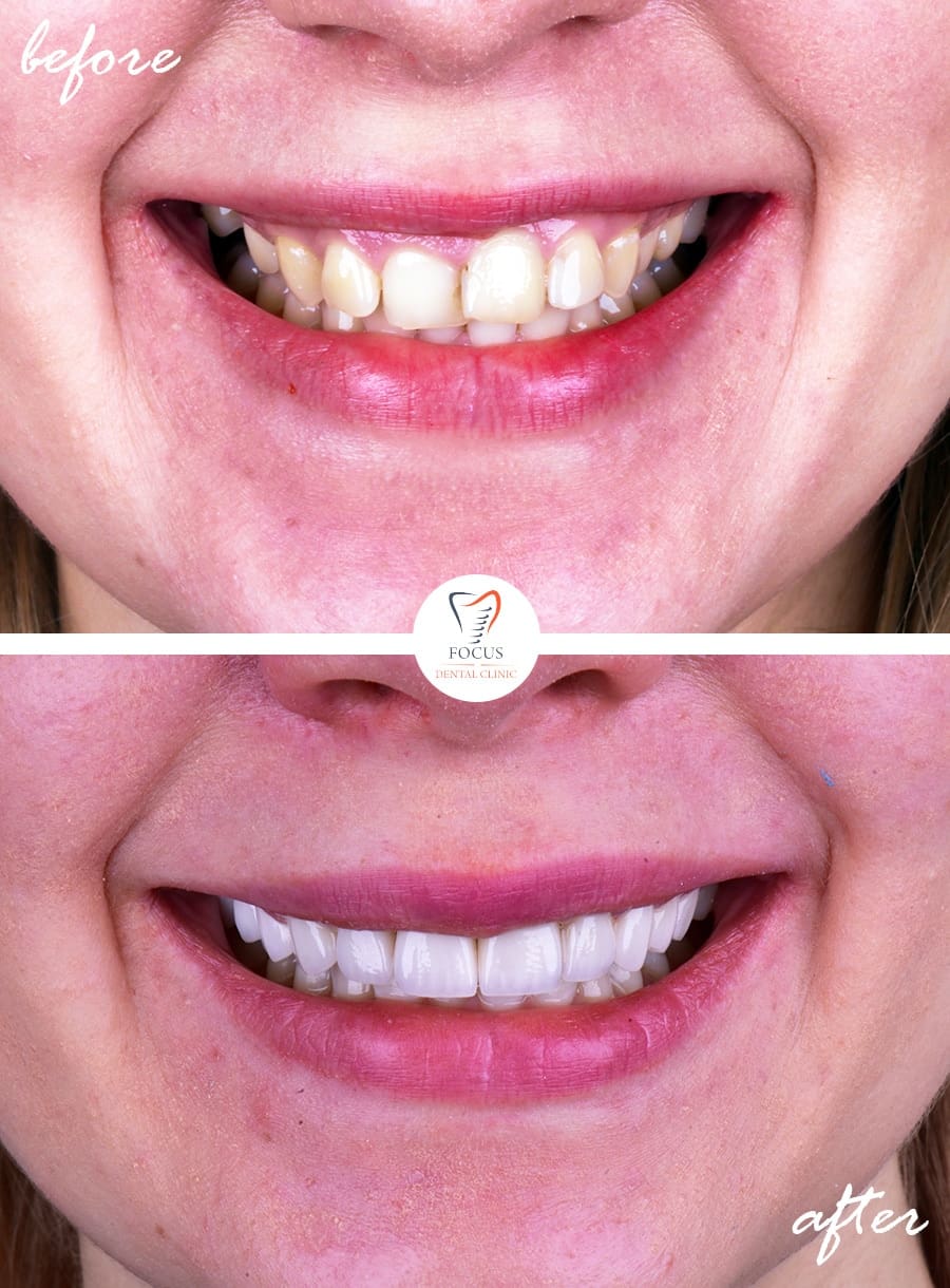Before-After-20