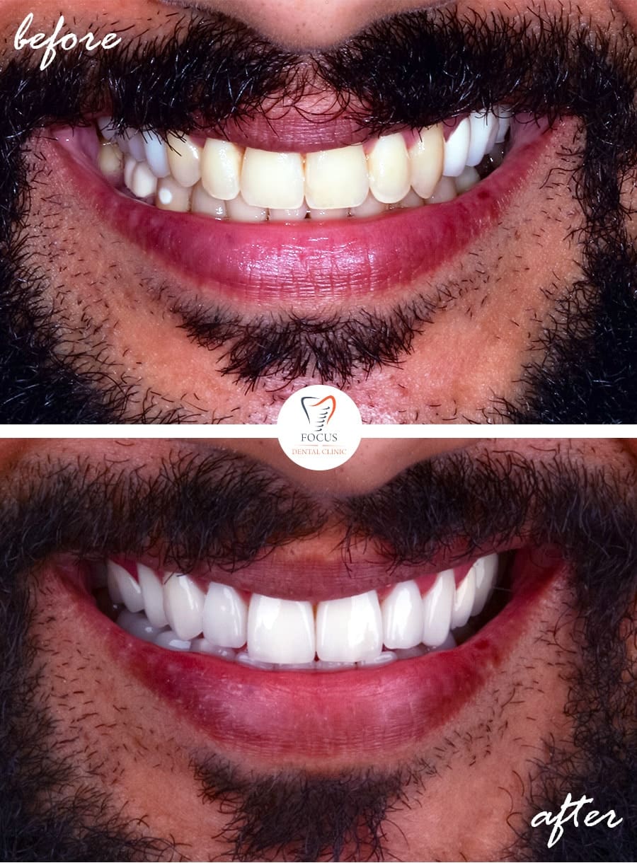 Before-After-21
