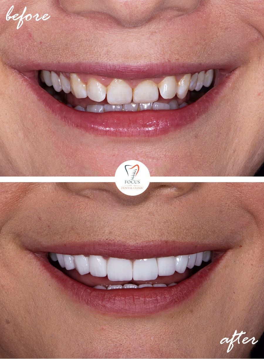 Before-After-28a
