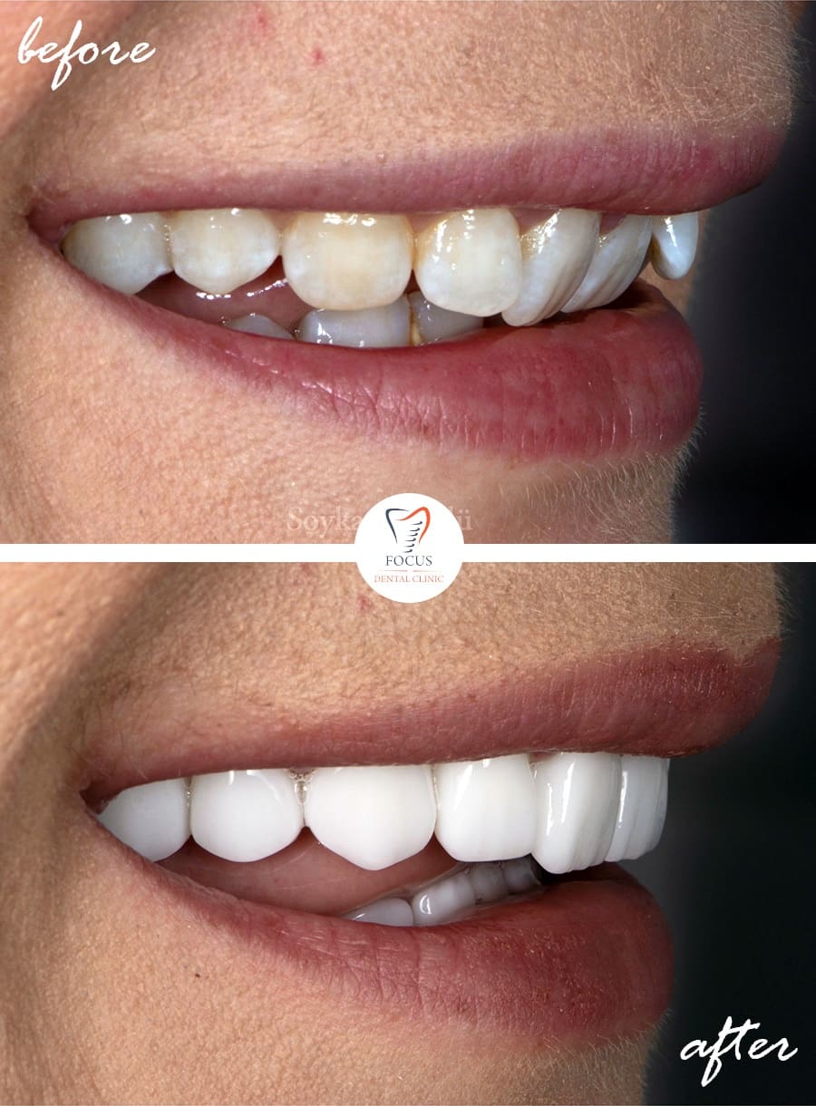 Before-After-28b
