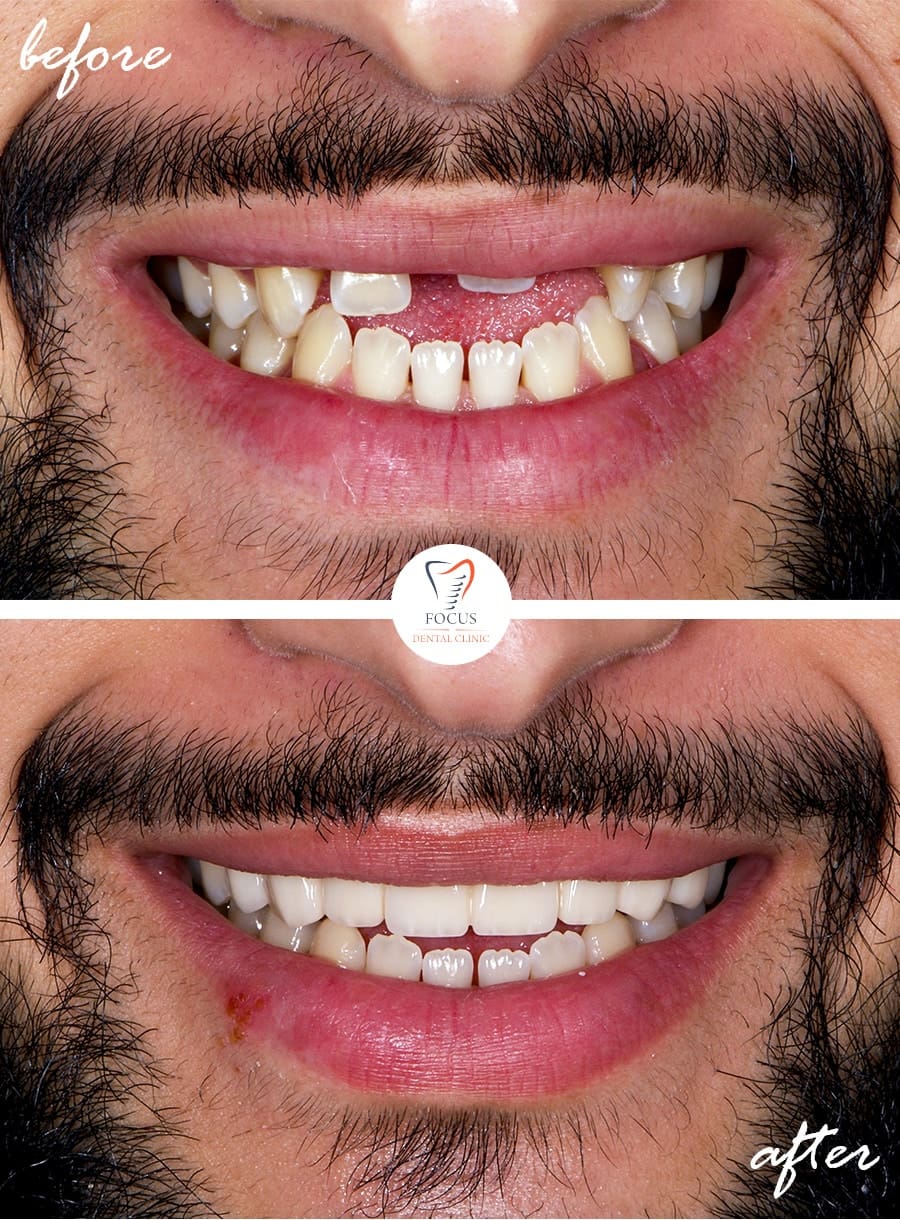 Before-After-29