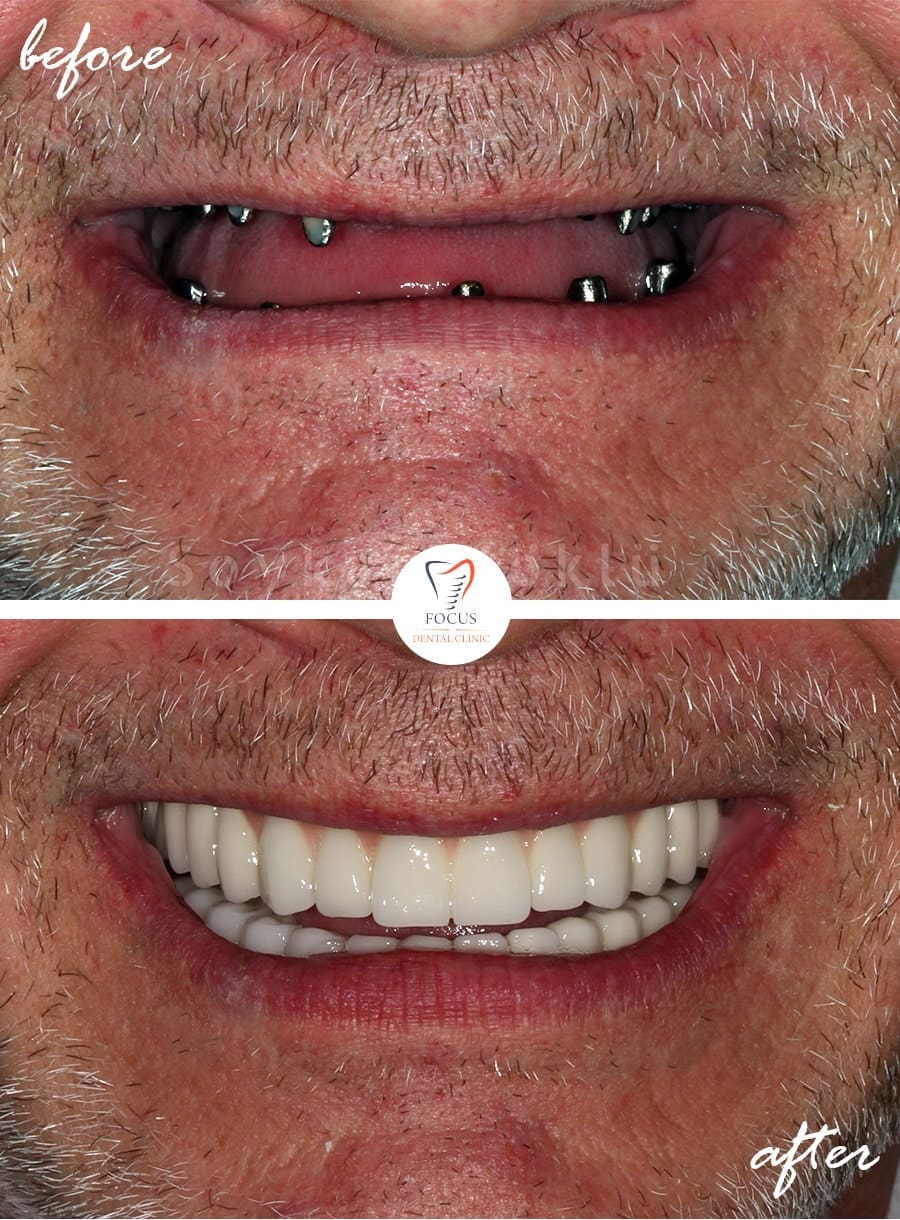 Before-After-31