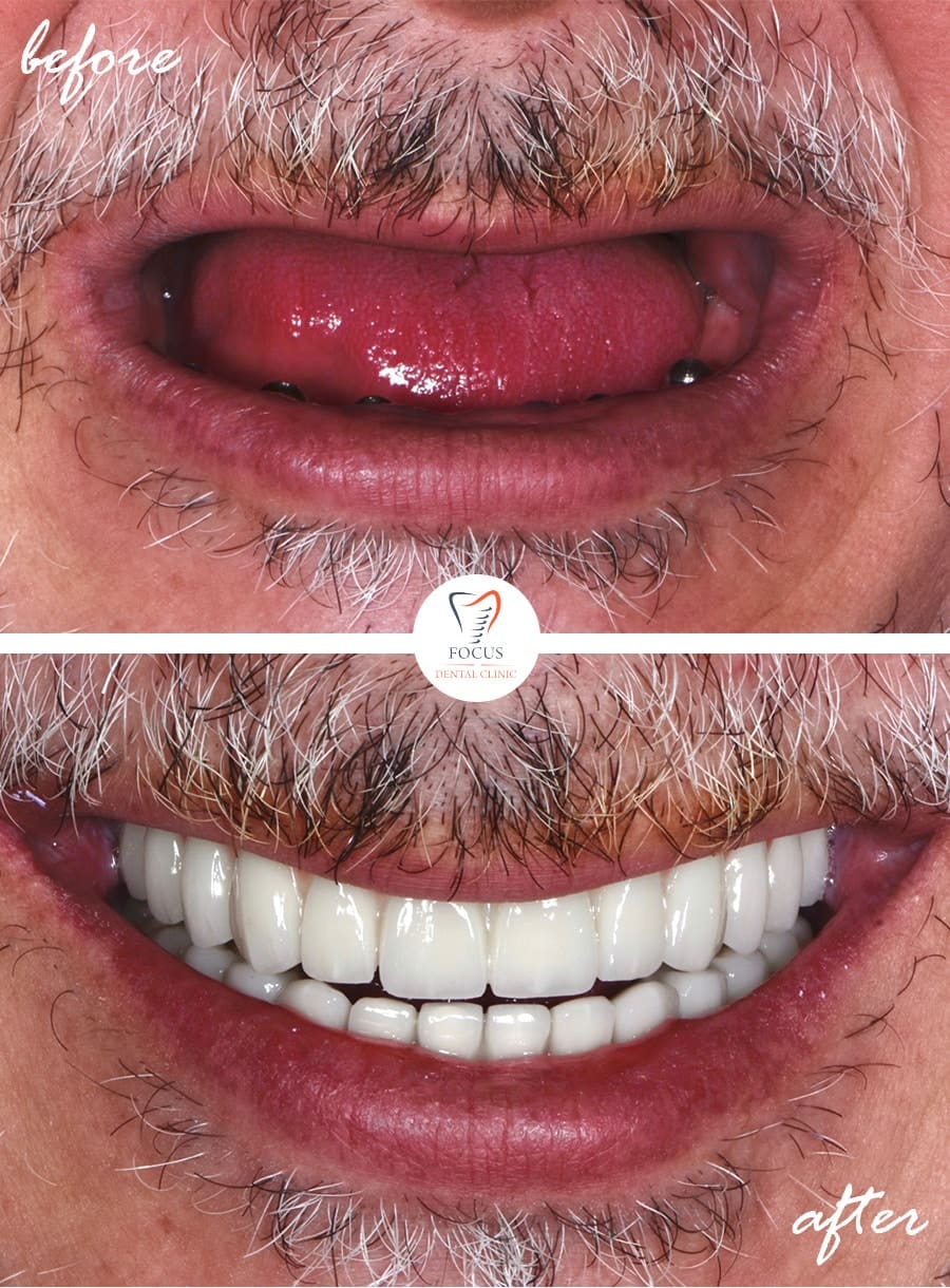 Before-After-33
