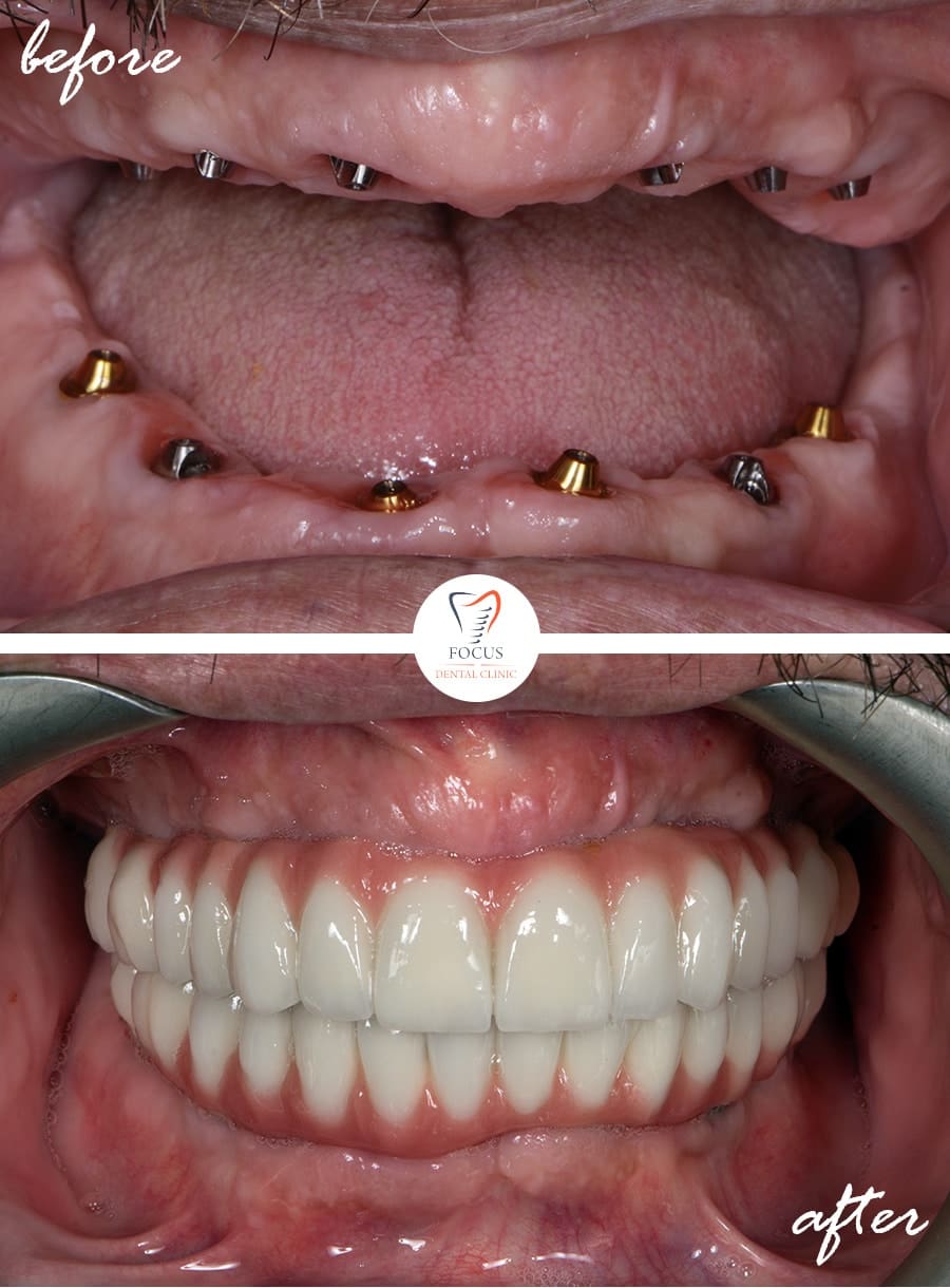 Before-After-35