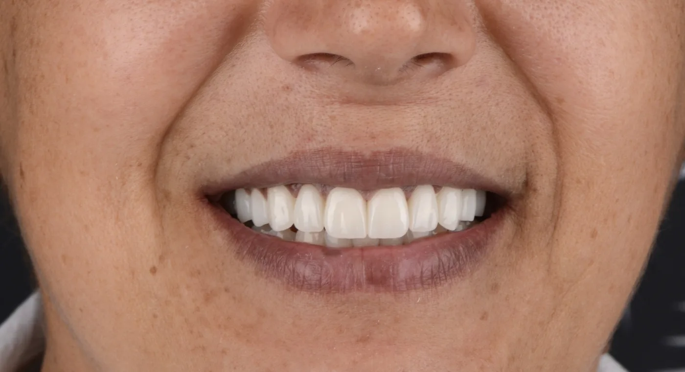 image after