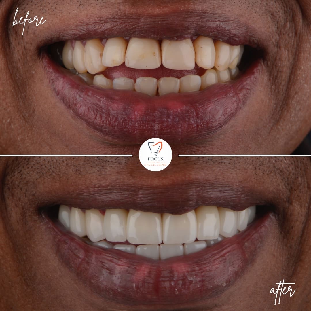 zirconia-crowns-02
