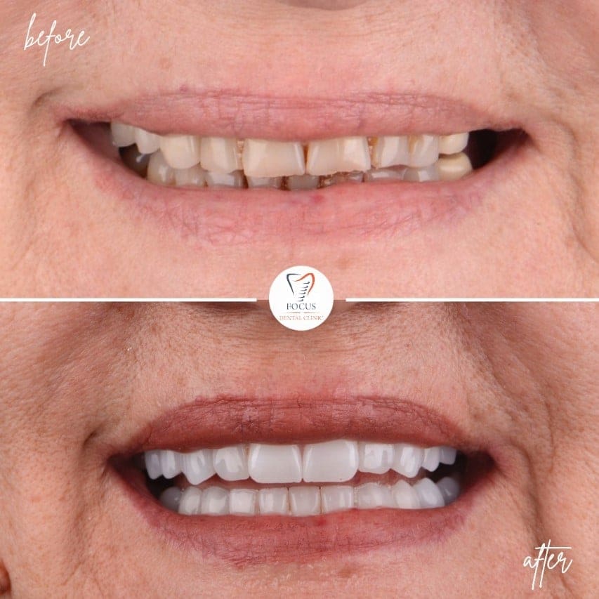 zirconia-crowns-05
