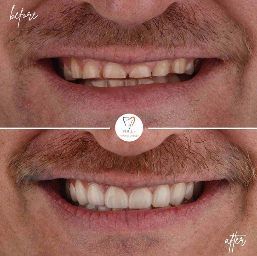 zirconia-crowns-10