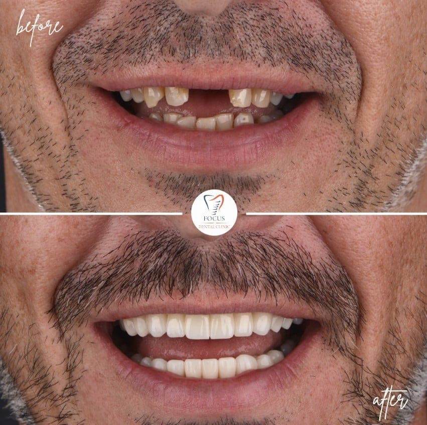 zirconia-crowns-14
