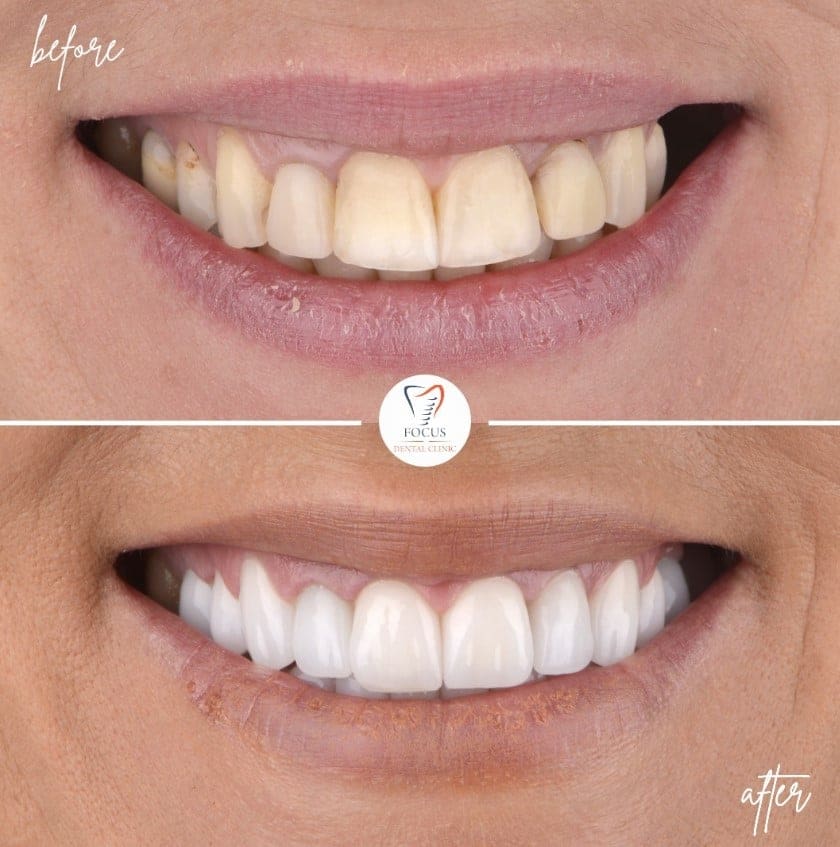 zirconia-crowns-15