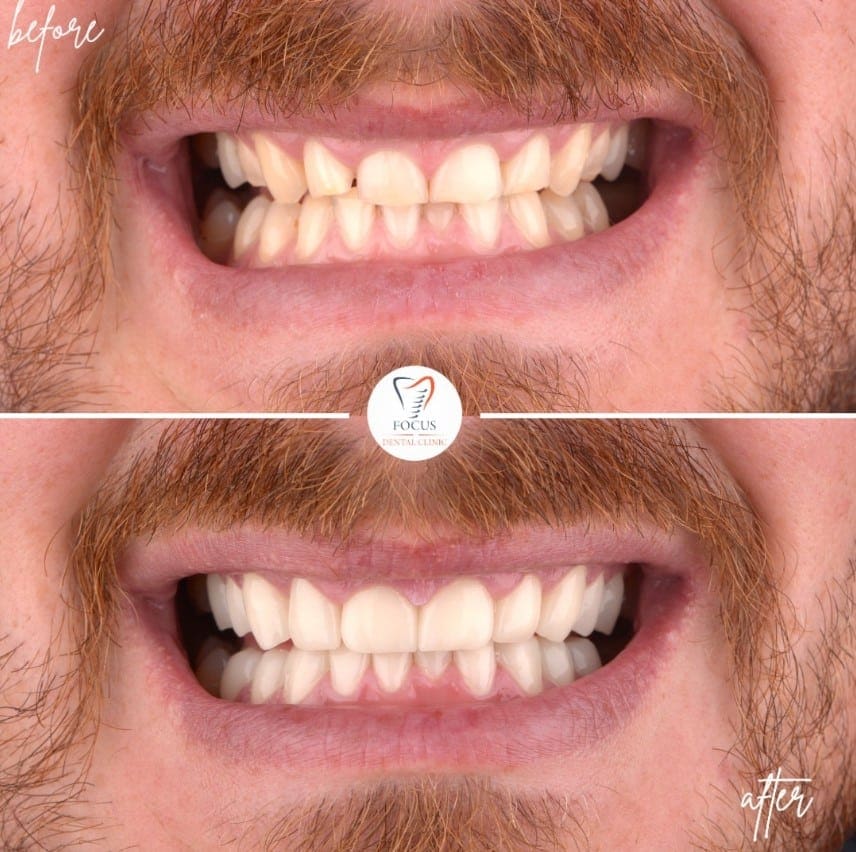 zirconia-crowns-16