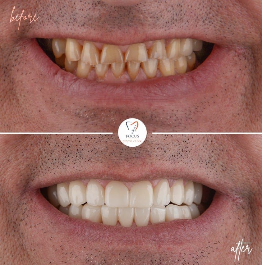 zirconia-crowns-17