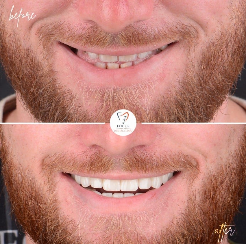 zirconia-crowns-19