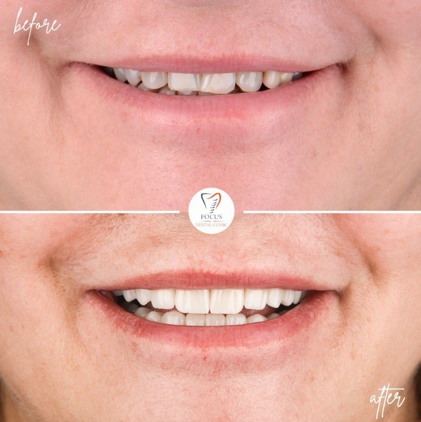 zirconia-crowns-23