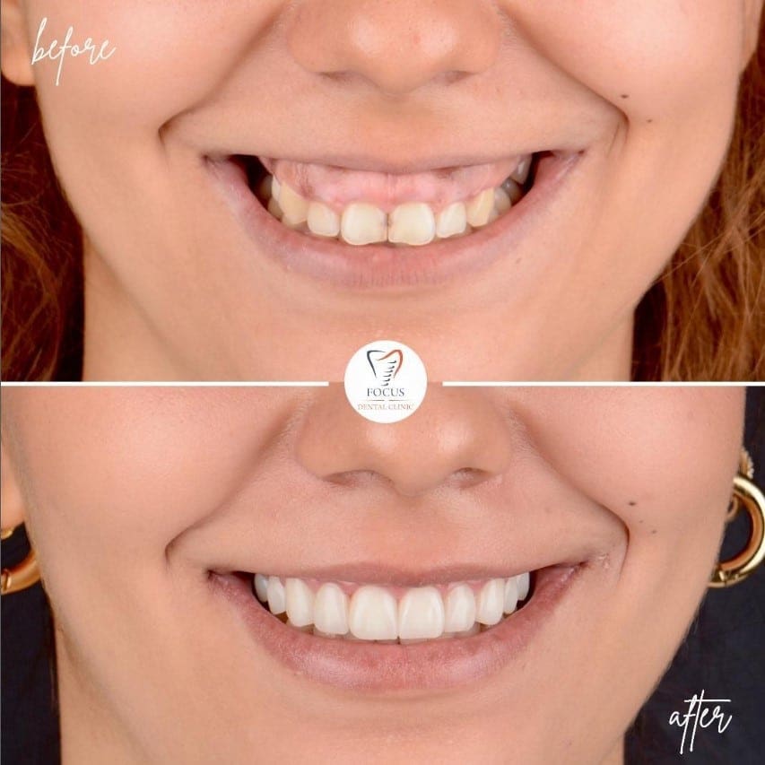 zirconia-crowns-26