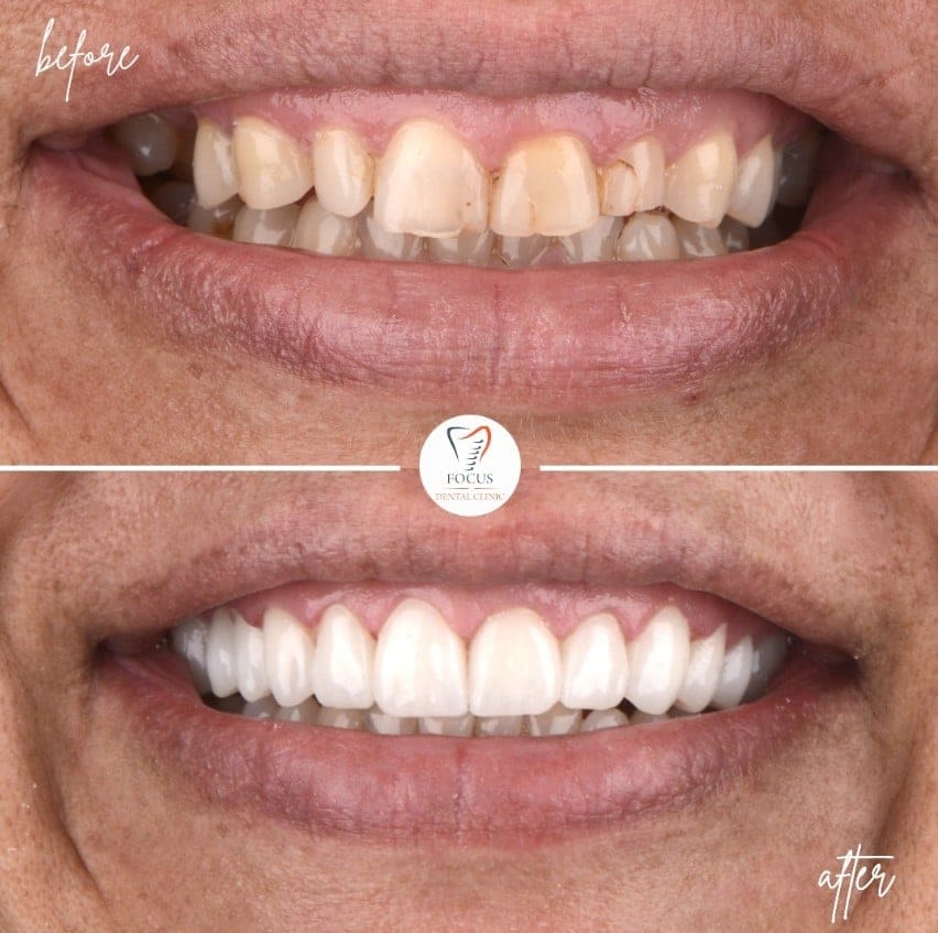 zirconia-crowns-27