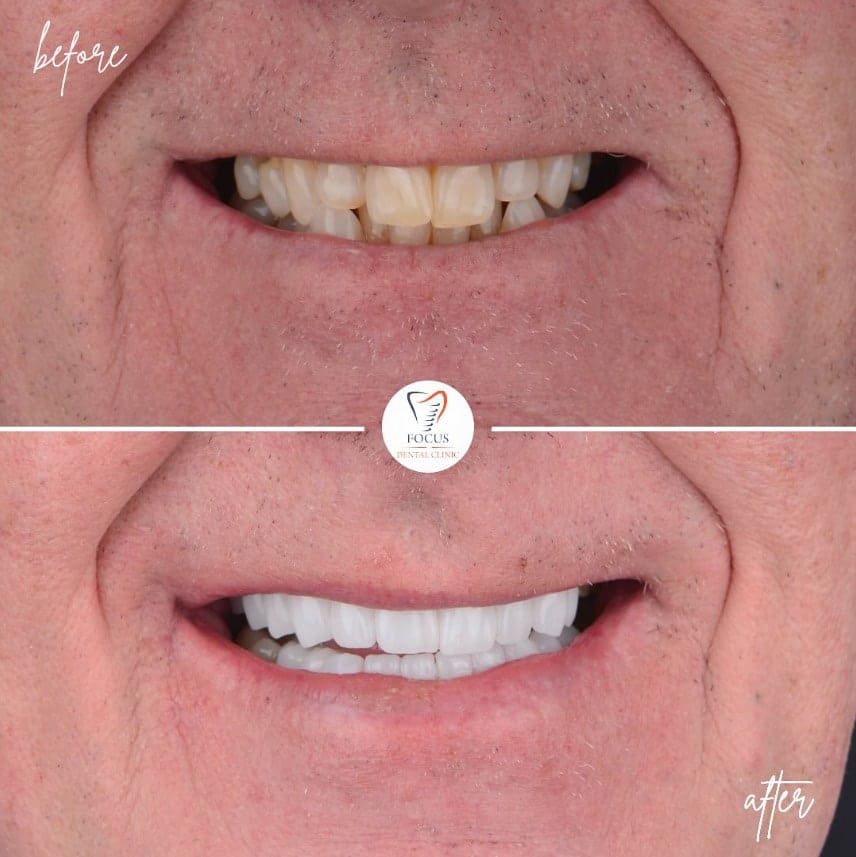 zirconia-crowns-29