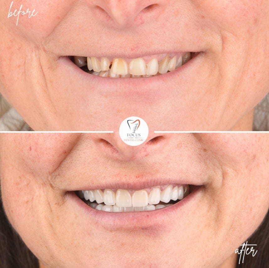zirconia-crowns-32