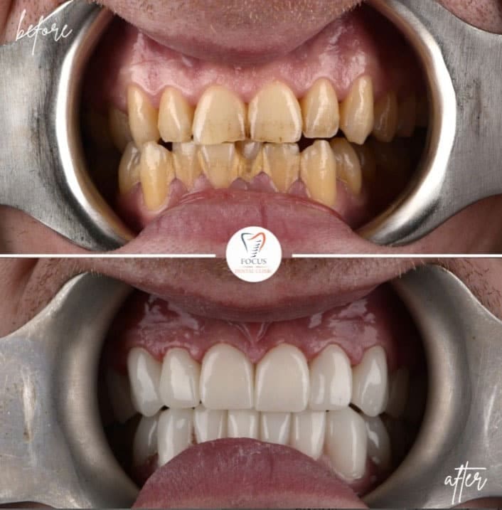 zirconia-crowns-33