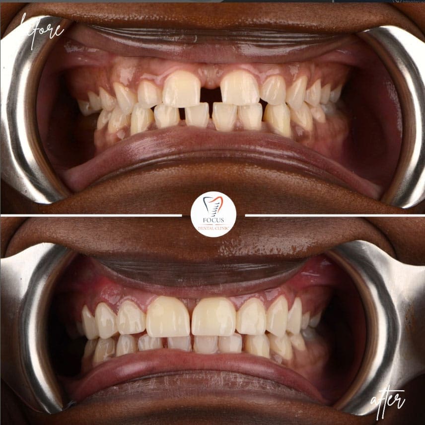zirconia-crowns-37