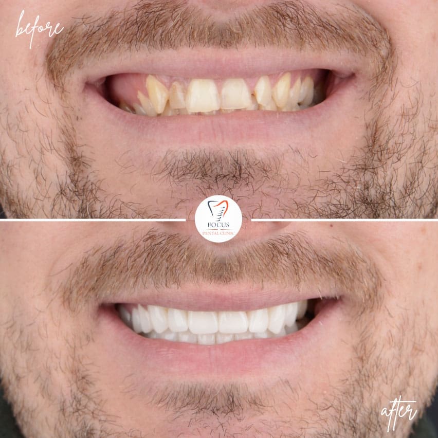 zirconia-crowns-39