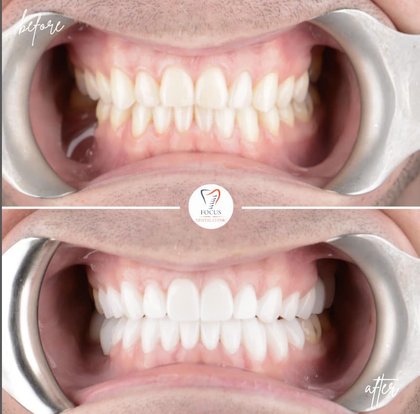 zirconia-crowns-40