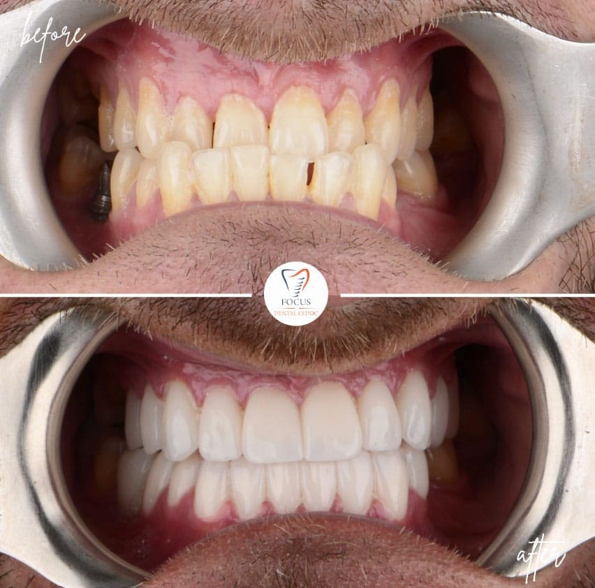 zirconia-crowns-43