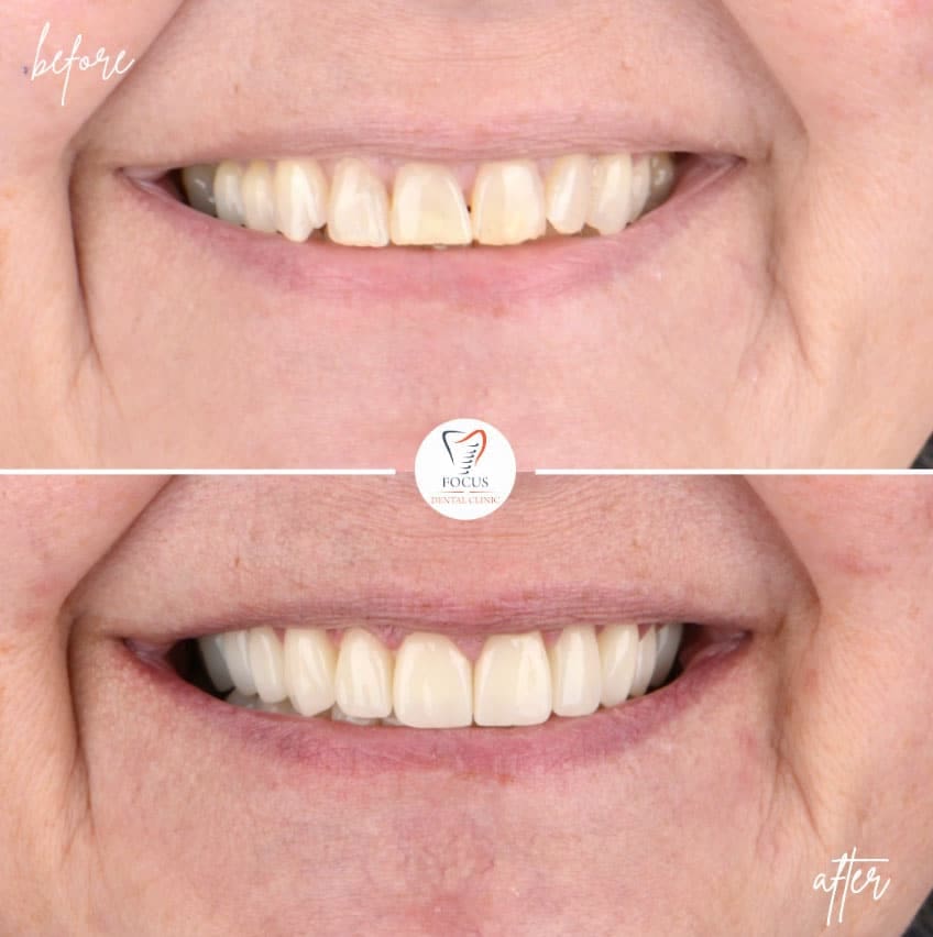 zirconia-crowns-46