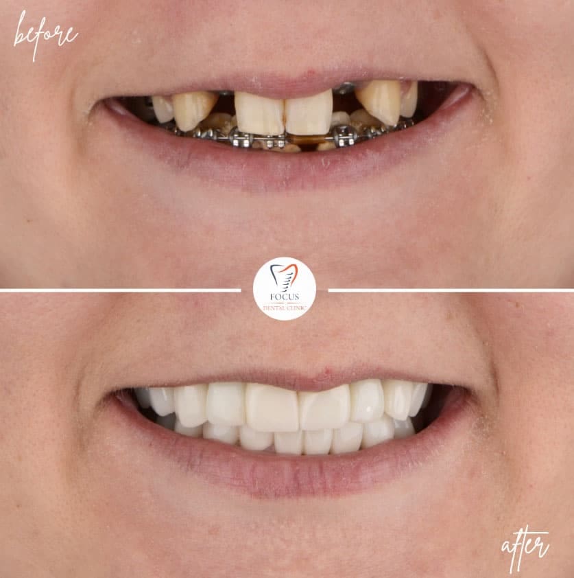 zirconia-crowns-50