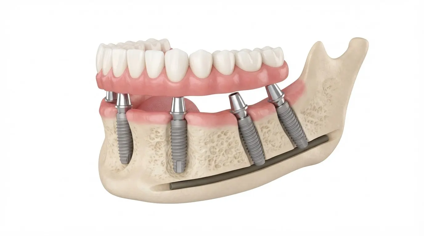 All-on-4 dental implant treatment at Focus Dental Bodrum