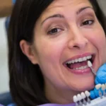 e-max veneers