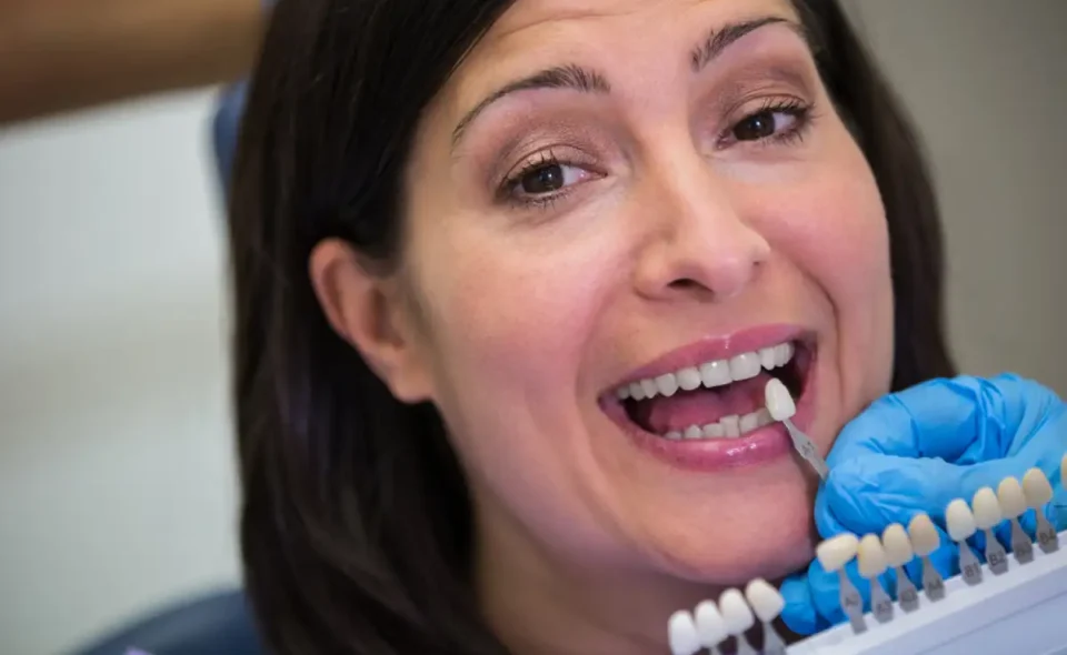 e-max veneers