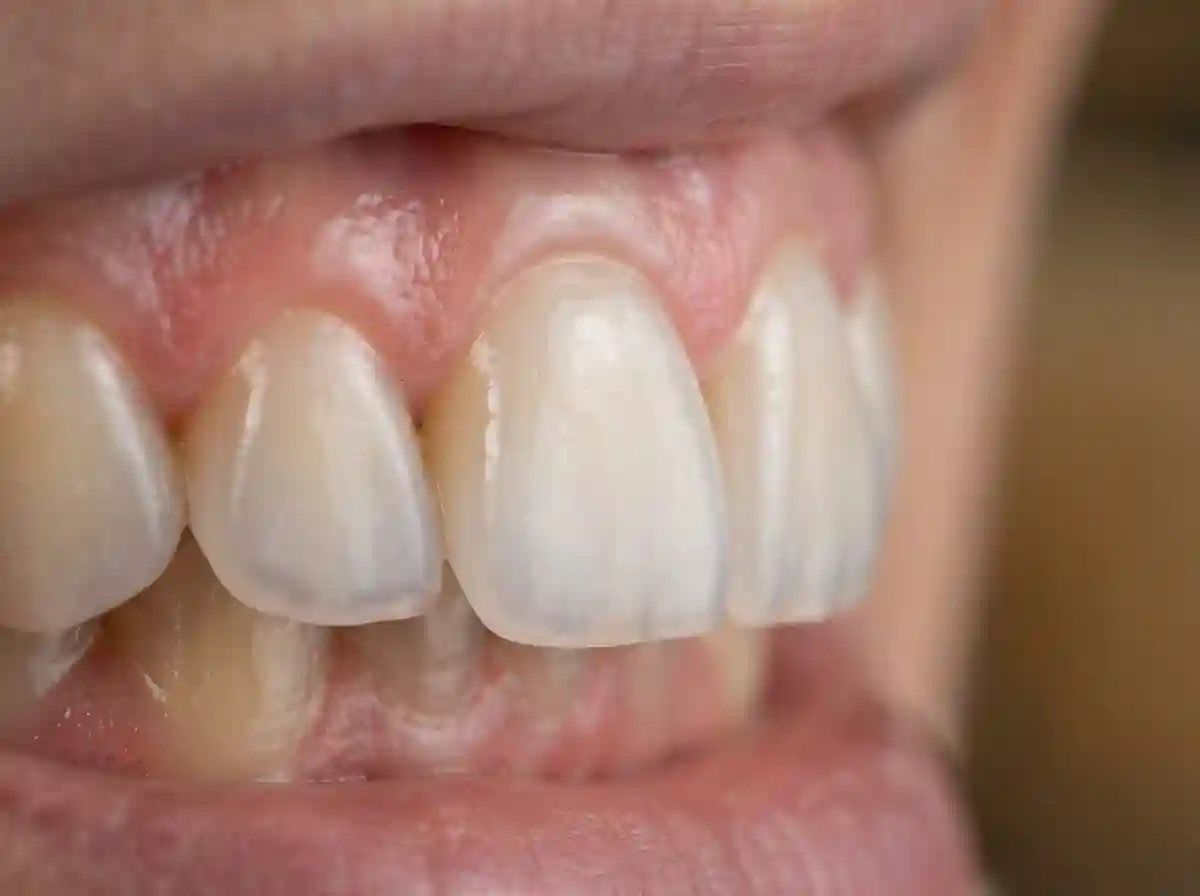 E-max Veneers Focus Dental Turkey