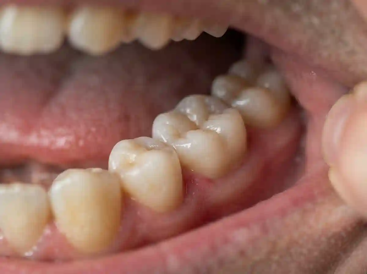 Zirconium Crowns at Focus Dental Turkey